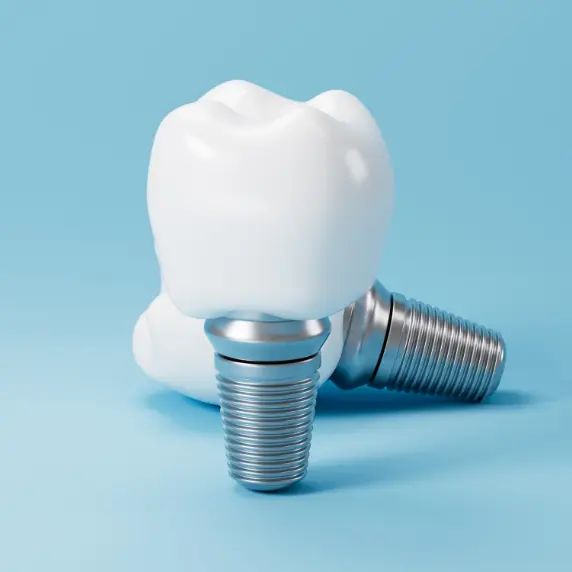 Vieno danties implantacija – greitai, tiksliai, patikimai!
