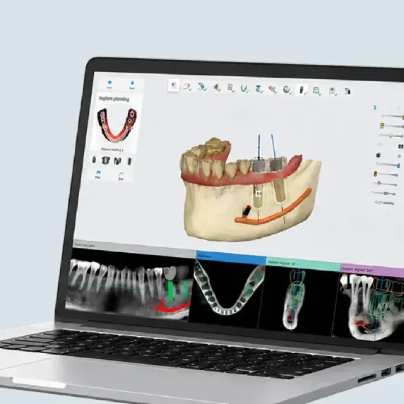 Tikslioji dantų implantacija